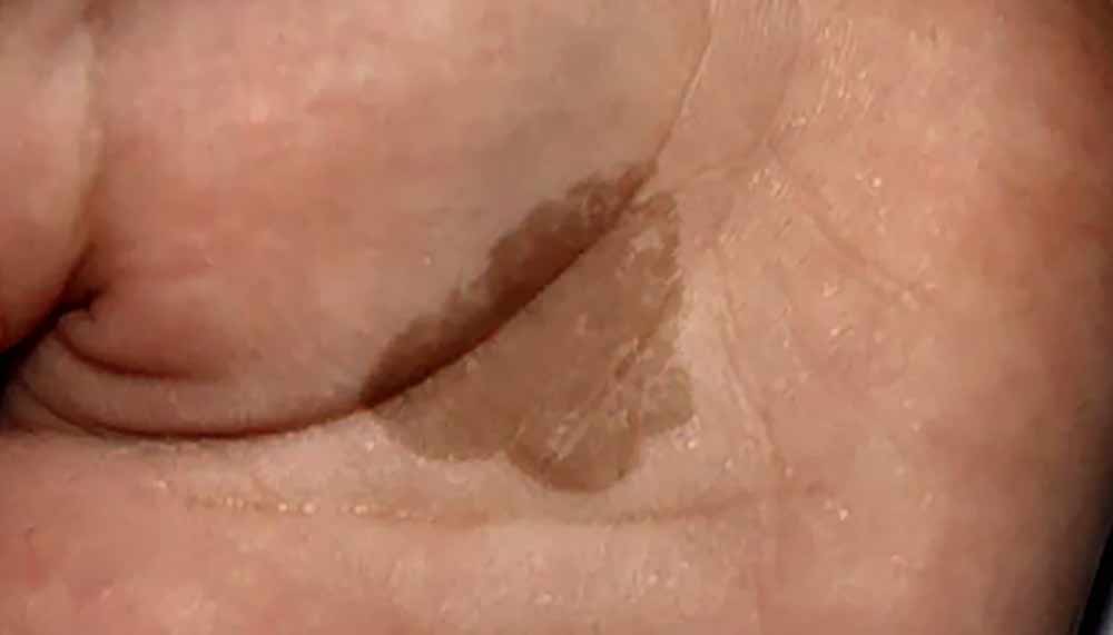 skin mold